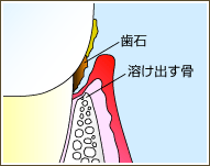 【P2】 軽度歯周炎 